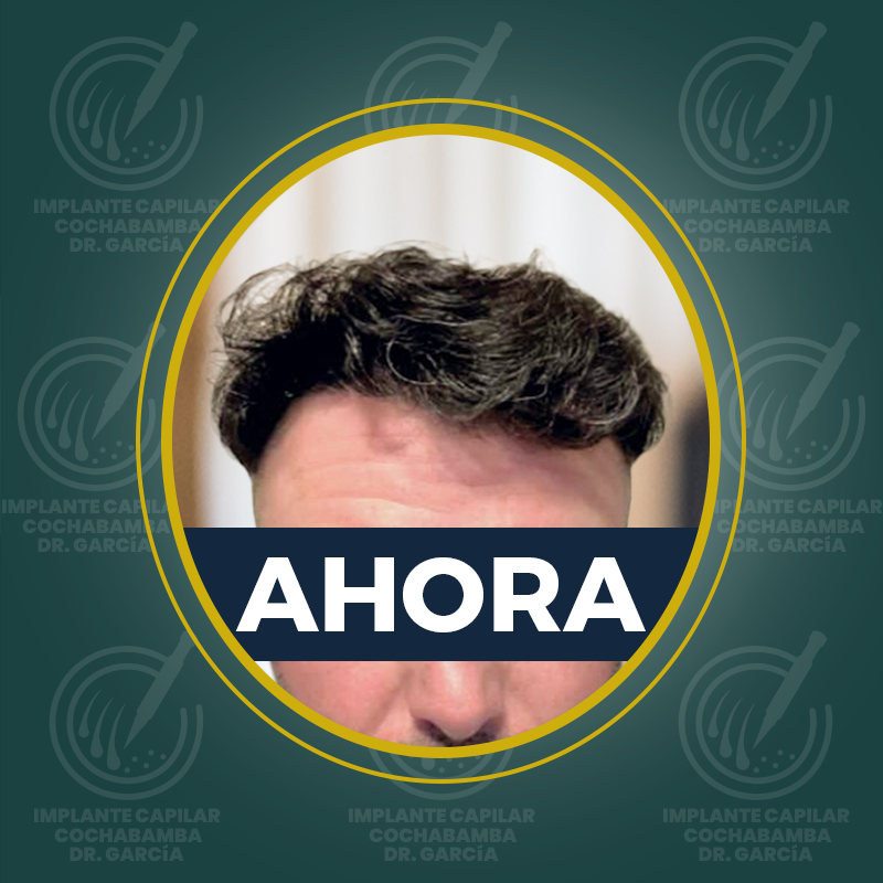 undefined - Después