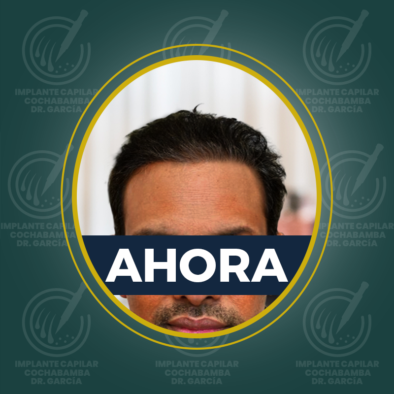 undefined - Después