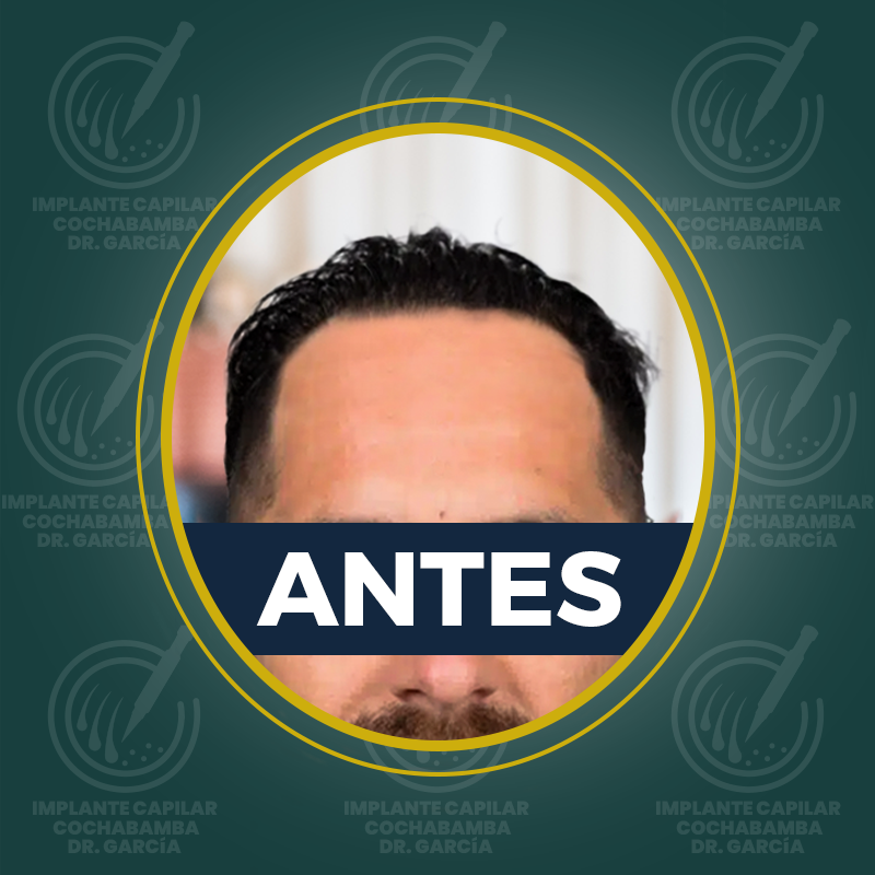 undefined - Antes