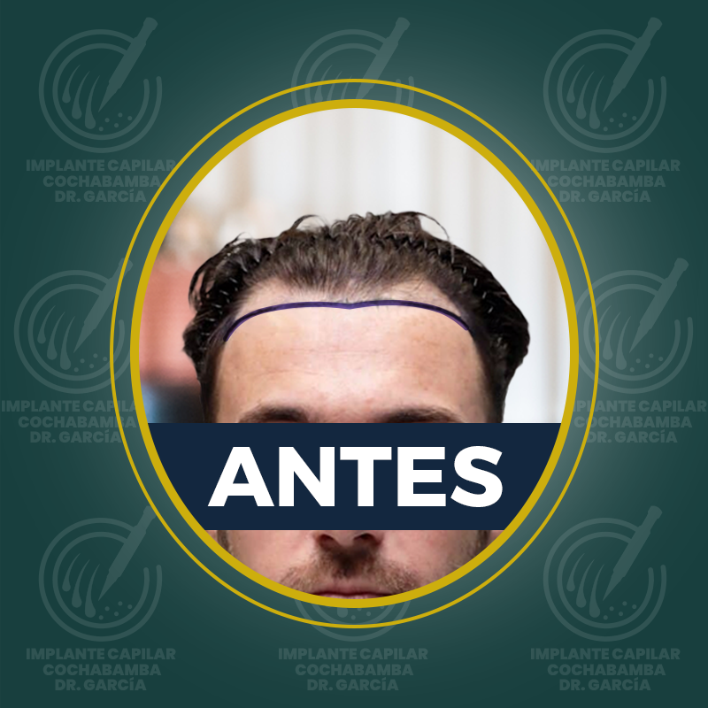 undefined - Antes