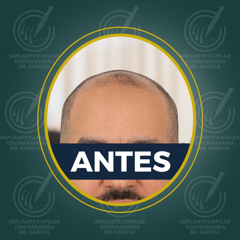 undefined - Antes