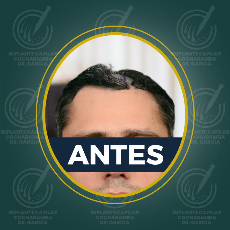 undefined - Antes