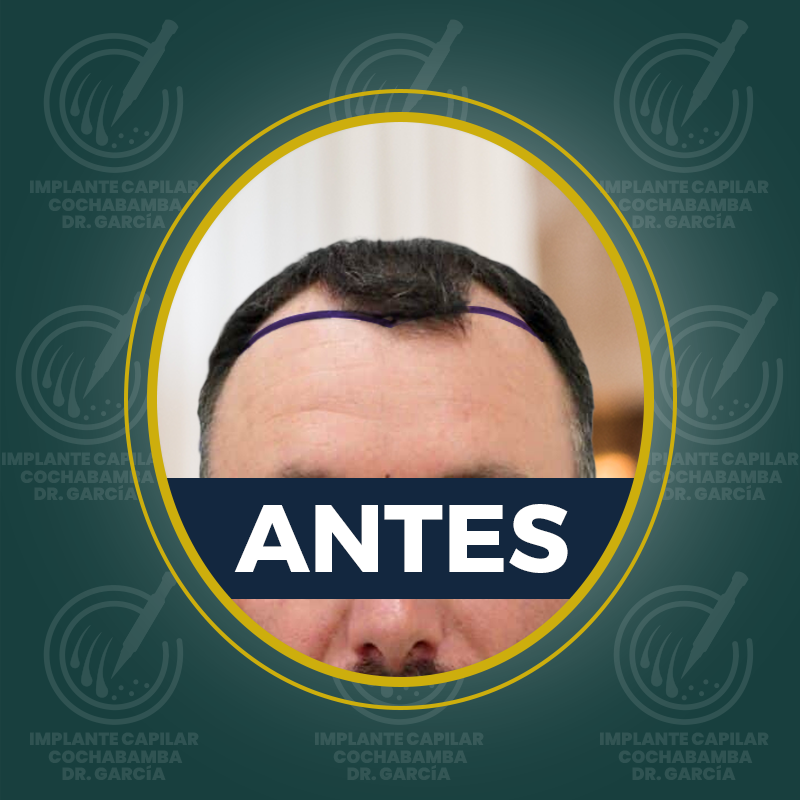 undefined - Antes