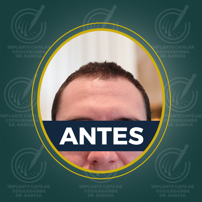 undefined - Antes