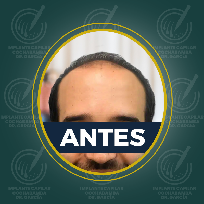 undefined - Antes