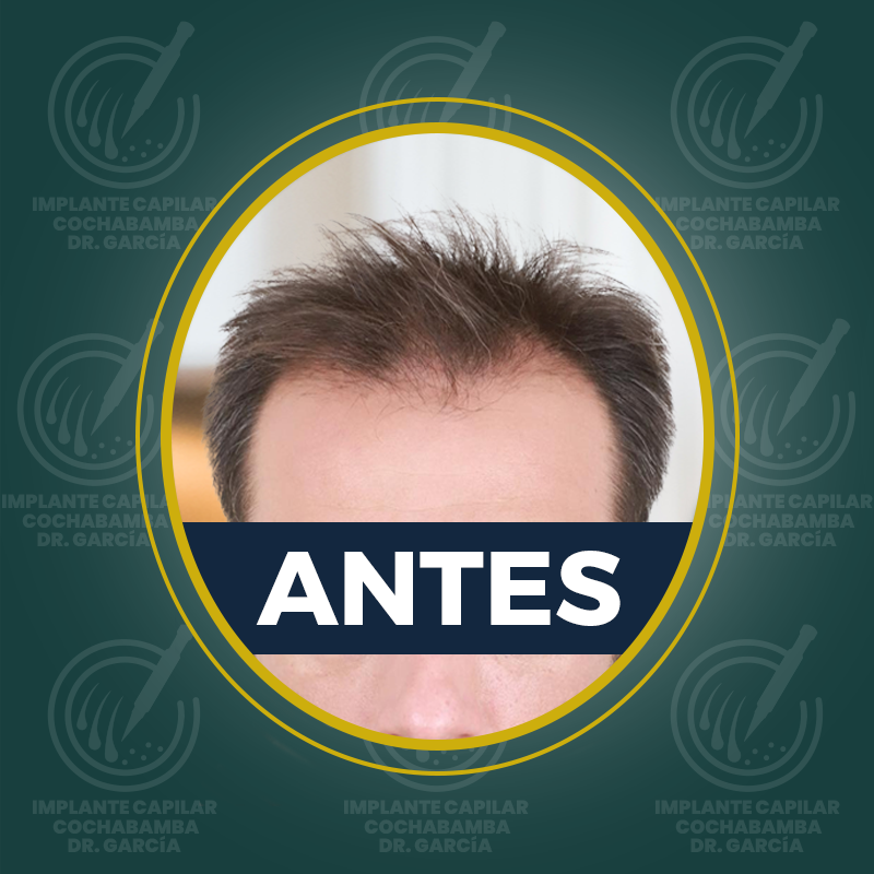 undefined - Antes