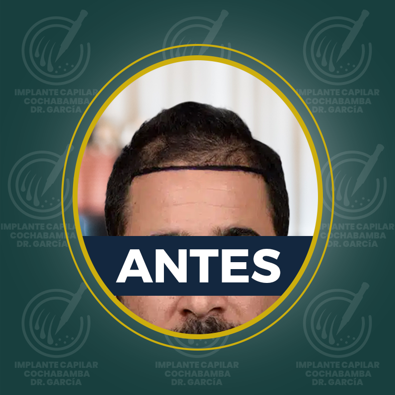 undefined - Antes