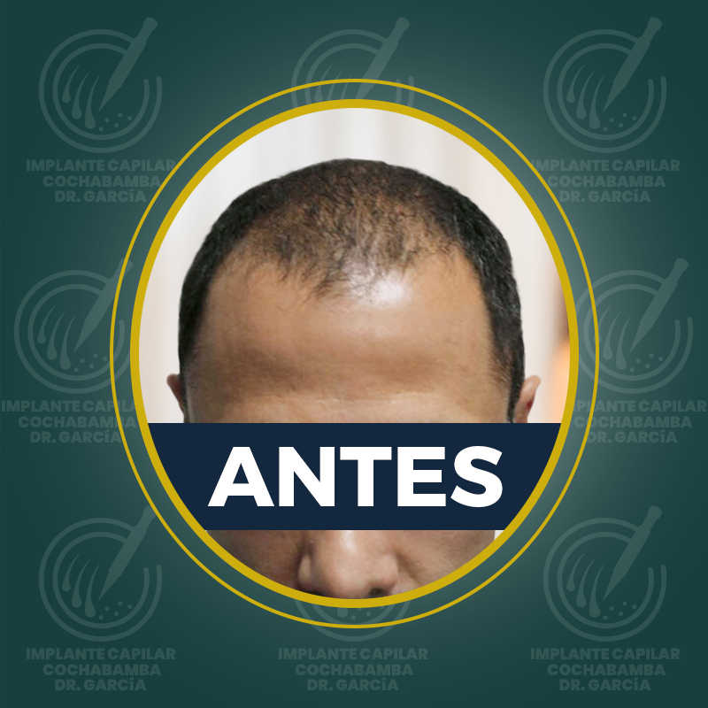 undefined - Antes