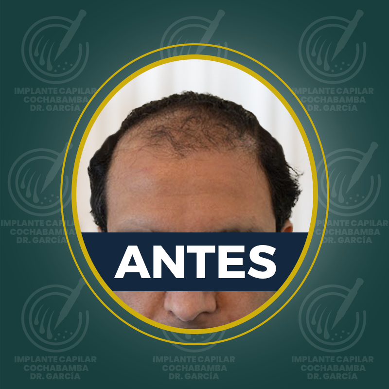 undefined - Antes