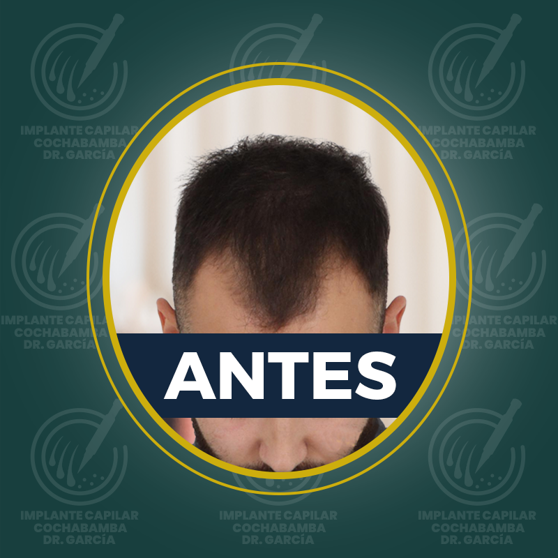 undefined - Antes