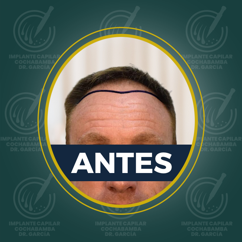 undefined - Antes