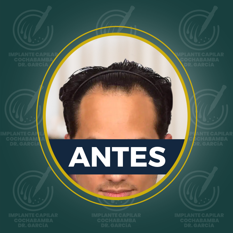 undefined - Antes